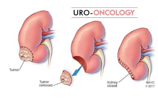 Best Uro Oncology Treatment in Sector 77, Noida