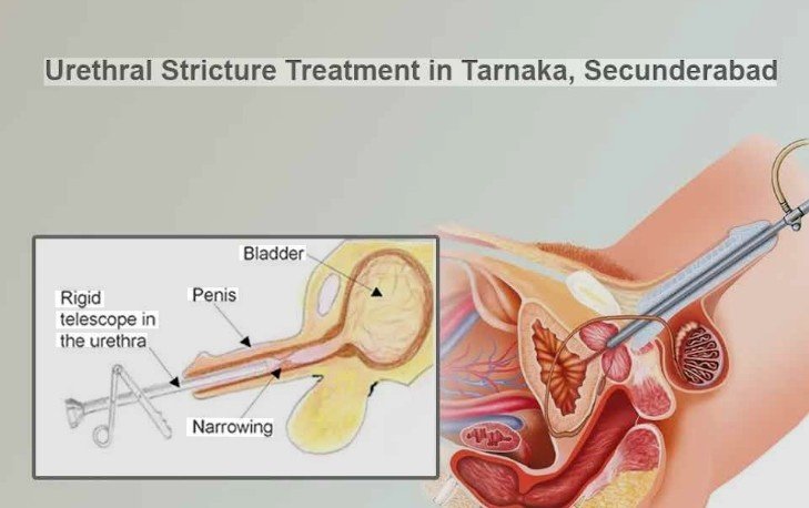 Stricture Urethra Treatment in Noida Extension