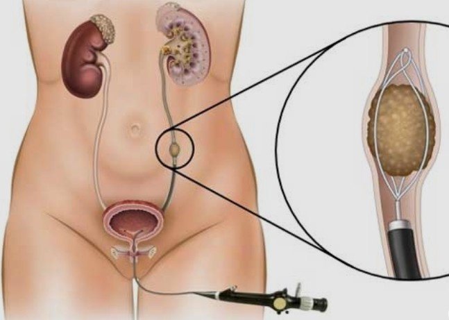 Endoscopic Urinary Stone Surgery in Noida Extension