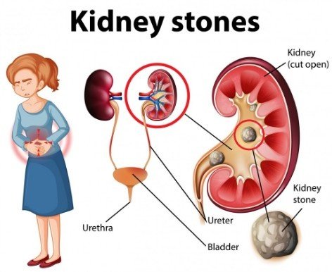 Best Kidney Stone Treatment in Noida