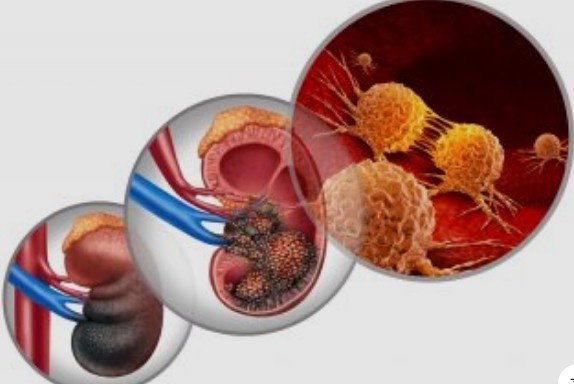 Best Urological Cancer Treatment in Noida