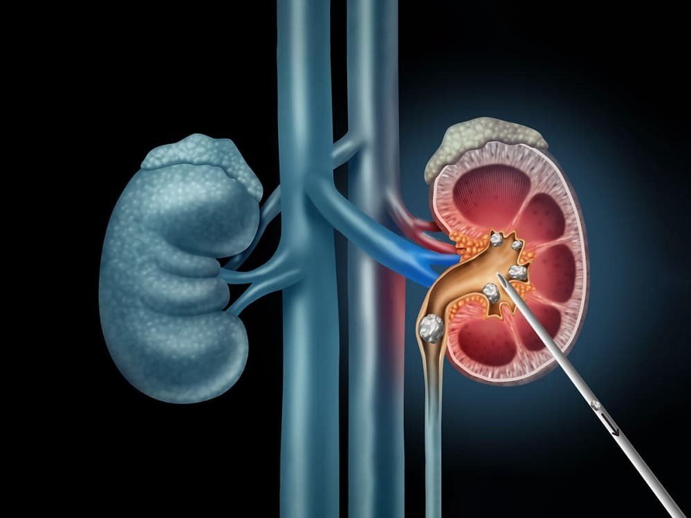 Best Kidney Stone Specialist in Noida